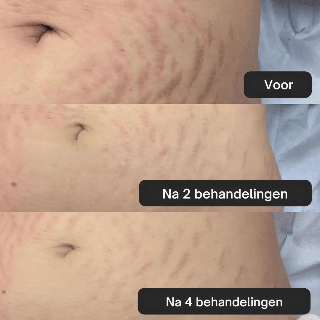 SoothingSkin Stretch Mark System