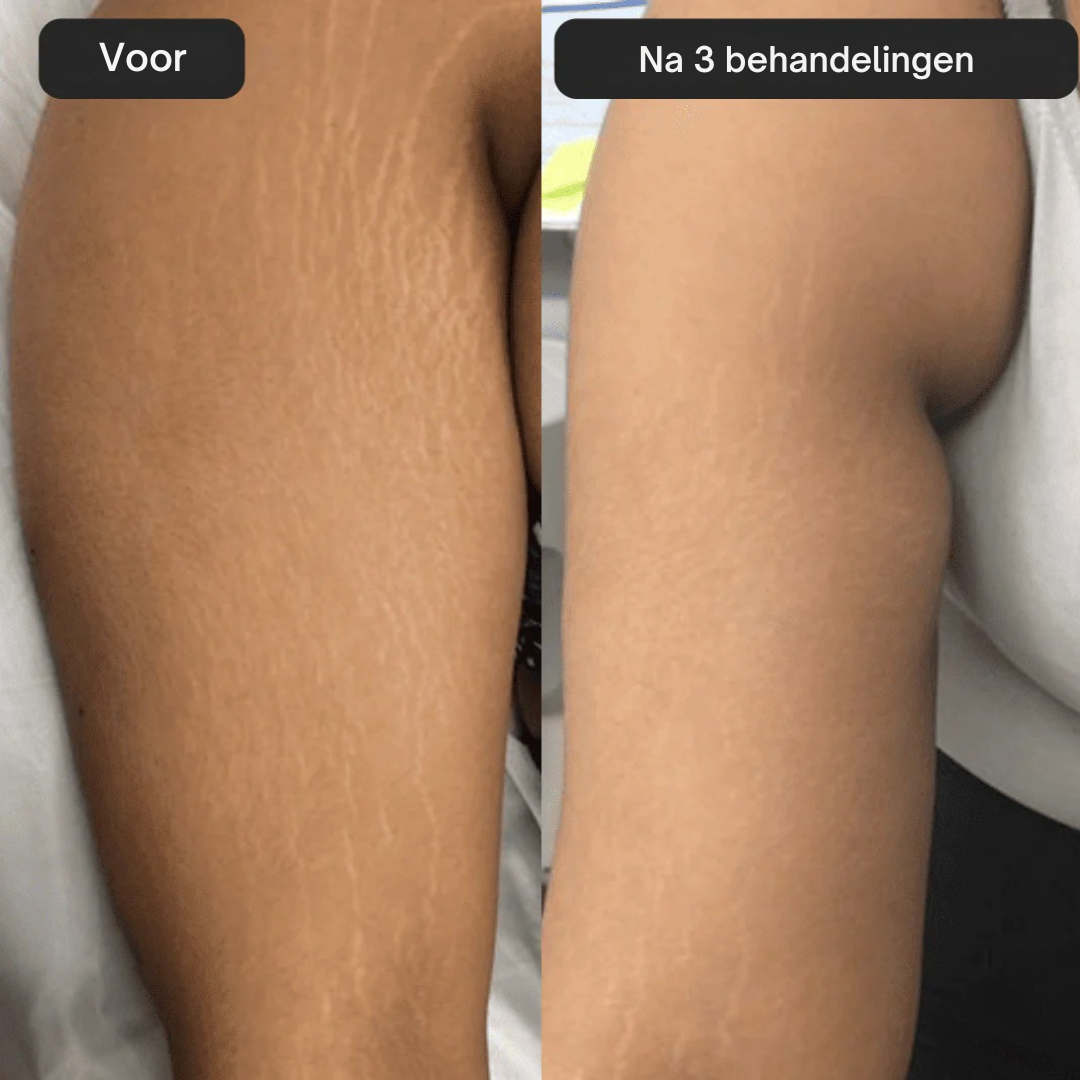 SoothingSkin Stretch Mark System
