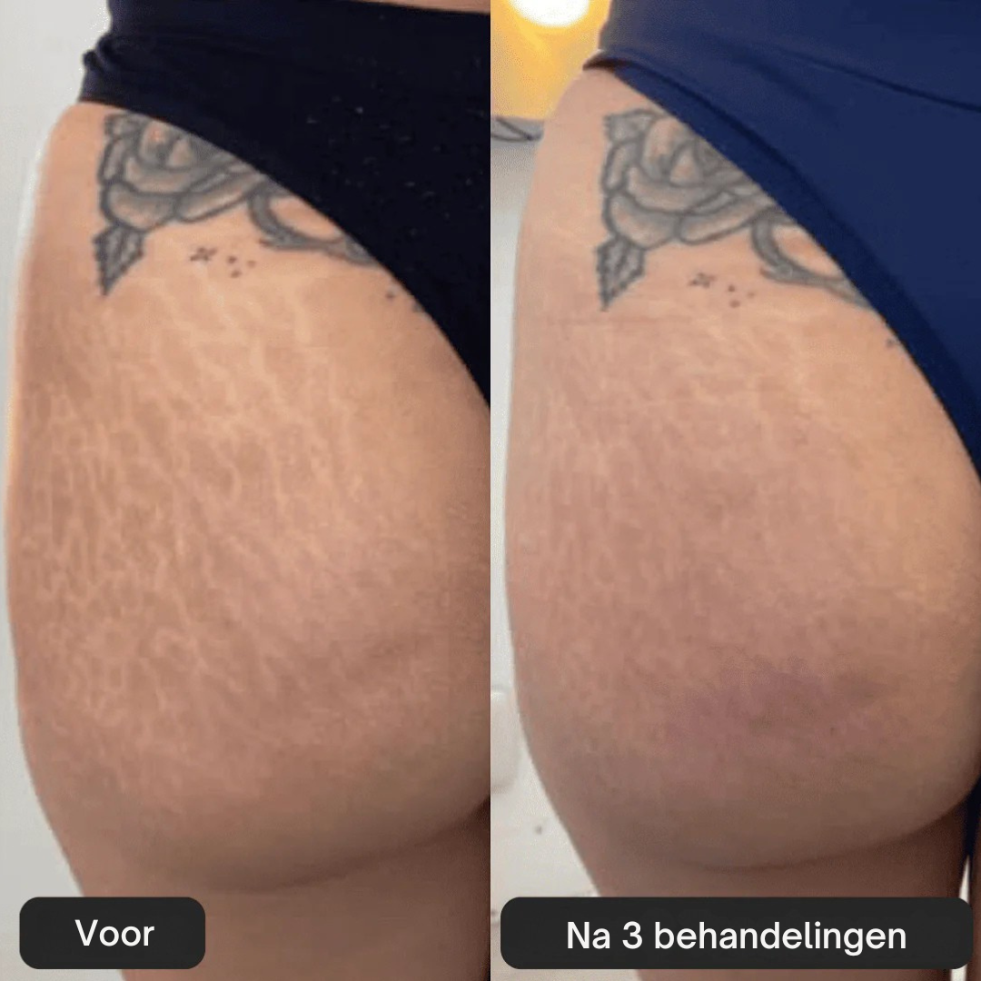 SoothingSkin Stretch Mark System