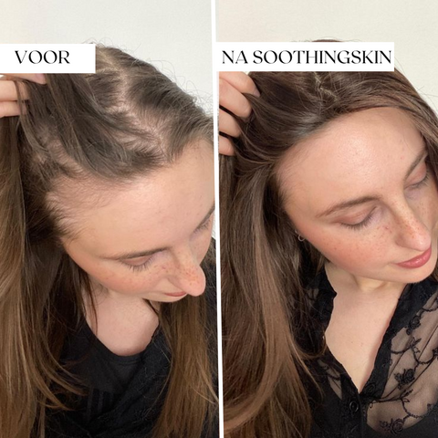 SoothingSkin Haargroeisysteem