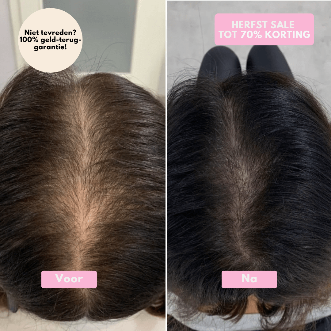 SoothingSkin Haargroeisysteem