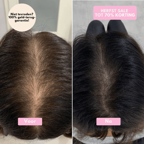 SoothingSkin Haargroeisysteem