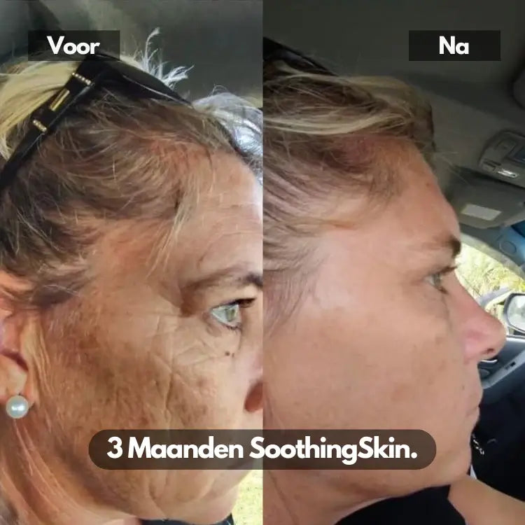 SoothingSkin Micro Infuussysteem