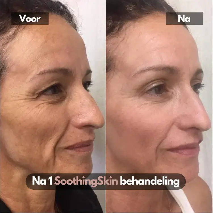 SoothingSkin Micro Infuussysteem