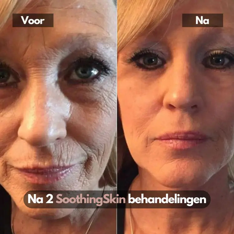 SoothingSkin Micro Infuussysteem